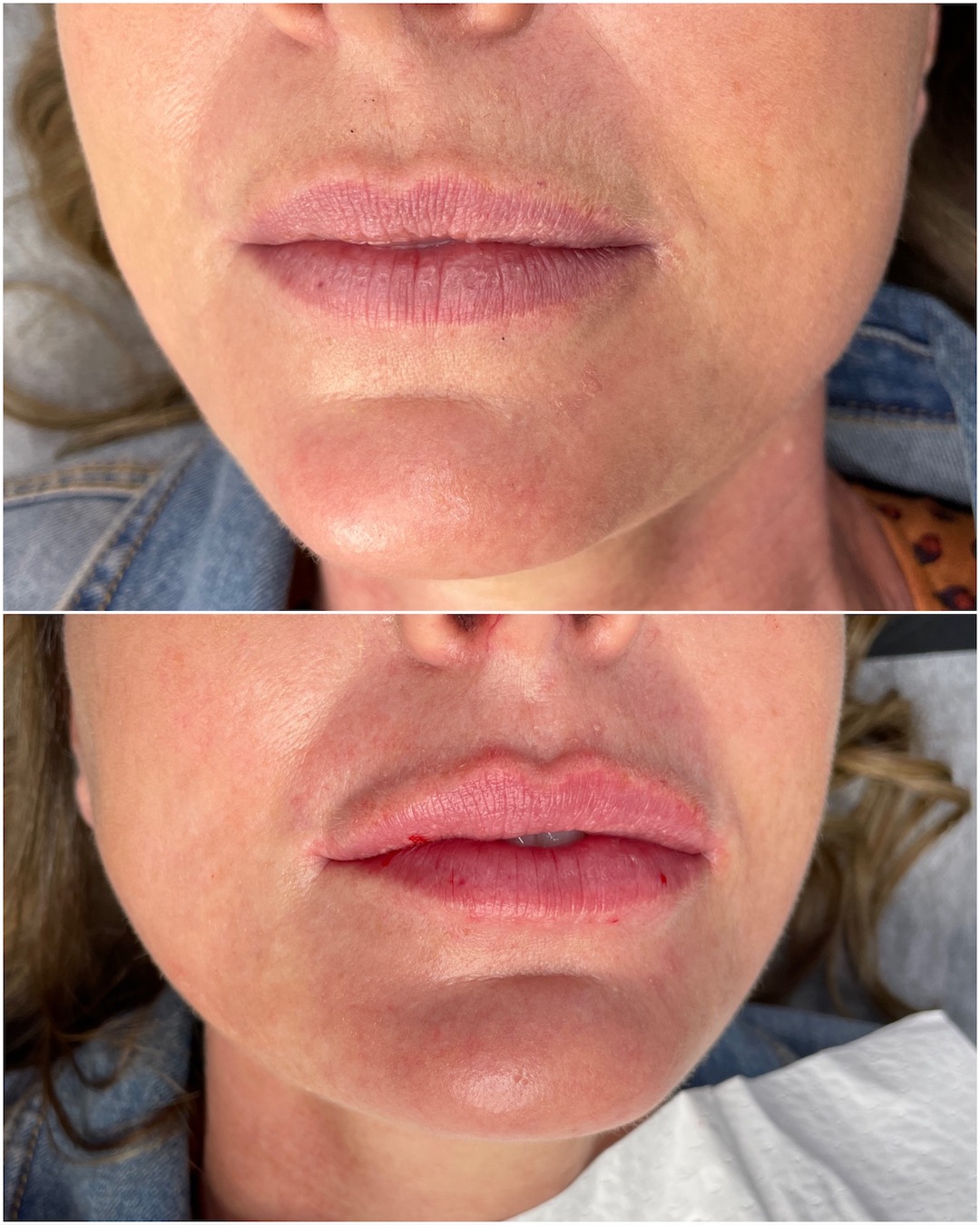 Difference between 1ml of thin, med and thick lip filler?(024)